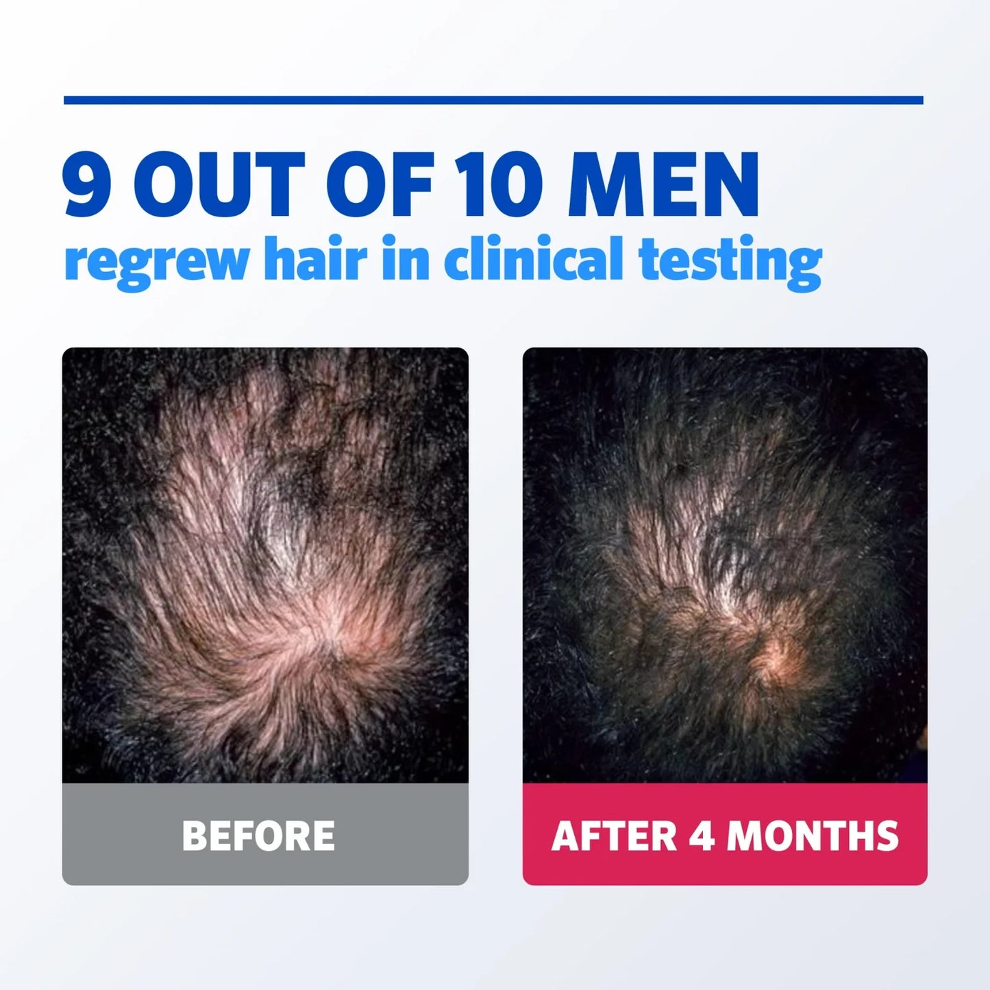 Kirkland Minoxidil 5% Hair Regrowth Solution Extra Strength Men 6 Month Supply